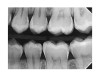 (18.) Radiograph of teenage patient showing maxillary left first premolar, which will be scheduled for disto-occlusal restoration, and all other proximal sites that will be treated with dental pick applied SDF. Additional application of SDF planned for 3 months and new bitewing films to be recorded in 6 months.