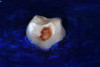 (26.) Silver modified atraumatic restorative technique (SMART) caries control treatment demonstrated on extracted carious primary molar.