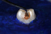 (27.) Silver modified atraumatic restorative technique (SMART) caries control treatment demonstrated on extracted carious primary molar.