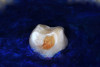 (28.) Silver modified atraumatic restorative technique (SMART) caries control treatment demonstrated on extracted carious primary molar.