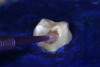 (29.) Silver modified atraumatic restorative technique (SMART) caries control treatment demonstrated on extracted carious primary molar.