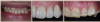 Fig 4. Dental rehabilitation completed in three appointments.