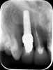 Fig 2. Radiograph showing implant was placed too deep and the diameter of the implant may be slightly larger than what was needed.