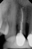 Fig 4. Radiograph showing root fracture and apical lesion of the tooth (No. 7).