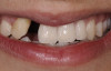 Fig 1. The patient presented with a large deformity stemming from a congenitally missing maxillary right lateral incisor.