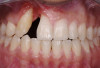 Fig 2. A failed implant and bone-graft procedures had resulted in a substantial iatrogenic gingival-alveolar defect.