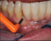 Fig 6. Customized oral hygiene to the implant-supported restoration with use of interdental brush;