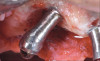 Fig 17. Implantoplasty of exposed implant surfaces.