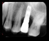 Fig 24. Radiographic image of affected implant before surgical therapy.