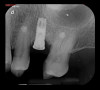 Fig 25. Radiographic image of affected implant one year after the surgical therapy.