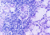 Fig 11. Histopathologic appearance of minor salivary gland biopsy (hematoxylin–eosin). Proliferation of myoepithelial cells (x400).