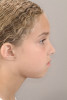 (5.) A 7-year-old girl who presented with mild convexity to her profile, lip incompetence, and a mild class II malocclusion.