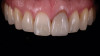 (2.) Case 2: Patient presentation of an asymptomatic, unesthetic full-coverage ceramic restoration on the maxillary left central incisor.