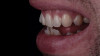 (15.) Case 1: Right- and left-side profile views of the definitive all-ceramic restoration on the maxillary right central incisor.
