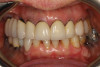 Fig 1. Preoperative retracted dentition.