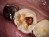Fig 9. Tooth No. 19 was broken and had deep caries.