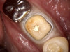 Fig 11. Tooth with a buildup material and with retraction cords impregnated with epinephrine.