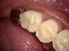 Fig 15. Postoperative photograph of the crown after the final cementation.