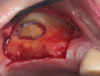 (1.) Preparation of lateral window for lateral sinus augmentation at the site of tooth No. 14.