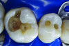 Figure 7. The occlusal outline was extended only to include carious enamel, provide access to the carious dentin, and remove any residual amalgam staining.