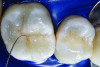 Figure 20. To create the illusion of occlusal fissure staining, a small amount of brown tint was placed using an 08 endodontic file (K-file, SybronEndo).