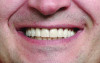 Figure 14. Post-treatment view of feldspathic porcelain veneers that restored length and color (photograph courtesy of Jurim Dental Laboratory).
