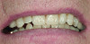 Figure 19. Final implant-supported bridge with no high esthetic demands.