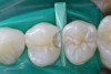 Fig 3. Minimally invasive Class II slot preparation maxillary first premolar.