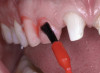 Fig 10. Use of an etch-and-rinse adhesive for a restoration with porcelain veneers.