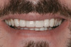 Fig 11. Immediate postoperative view of porcelain veneers and all-ceramic crowns placed using an etch-and-rinse adhesive.