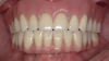 Fig 8. Implant- and mucosa-supported removable overdentures.