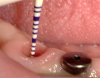 Fig 12. Periodontal probe used to measure the distance from the implant platform to the crest of the peri-implant tissue.