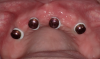 Fig 15. Block-out rings placed to block the undercuts between the denture caps and tissues.