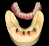Fig 18. Conical abutments were used to retain an implant-supported removable prosthesis.