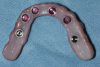 Fig 30. The denture attachment housings (pink) were picked up in the prosthesis.