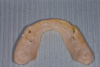 (4.) Wear damage to the custom-fabricated tray, indicating nocturnal bruxism.
