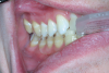 (8.) The disadvantage of thermoplastic trays is that they only come in one size; therefore, for patients with larger arches, some of the teeth may not be covered and, thus, will not be bleached.