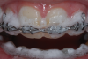 (12.) When 10% carbamide peroxide is injected onto the braces, it immediately begins foaming upon contact with the plaque.