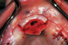 Fig 4. The nasopalatine canal contains the nasopalatine artery, which usually hemorrhages when enucleated.