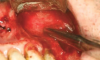 Fig 7. A hemostat may be used to crush bone on the lateral wall of the sinus to obtund bleeding from an intraosseous blood vessel.