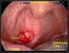 Fig 1. Oropharyngeal cancer. Image courtesy of Bechara Y. Ghorayeb, MD.