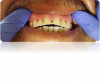 Fig 7. Erosion of the facial maxillary central incisor.