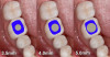 Fig 2. A comparison of several implant diameters to the emergence profile shape of a mandibular molar shows how much emergence in the restoration would be required to replicate the missing tooth.