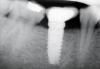 Fig 5. Example of an implant that is placed too shallow, such that the emergence profile of the implant crown cannot be made to an ideal profile, leading to potential food trap issues.
