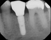 Fig 6. Example of an implant placement at an appropriate depth of at least 2 mm to 3 mm below the CEJ of the adjacent teeth. This allows for vertical height space to create an ideal emergence profile.