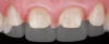 Fig 5. Short tooth preparations with long anterior crowns.