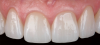 Fig 6. Anterior crowns fabricated from monolithic 4Y zirconia, which was chosen because of its desired balance of strength and translucency.