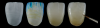 Fig 7. Fabrication of a monolithic 5Y zirconia crown. Left to right: pre-sintered crown received from mill with slight hand-carved texturing, pre-sintered crown with painted dip stains, sintered crown, sintered crown with external staining.