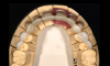 Fig 9. Zirconia coping in which all functional movements of the opposing teeth are located on the coping (Fig 9, occlusal view; Fig 10, facial view).