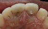 Fig 11. Fracture of lingual lithium-disilicate anterior crowns due to insufficient restoration thickness.
